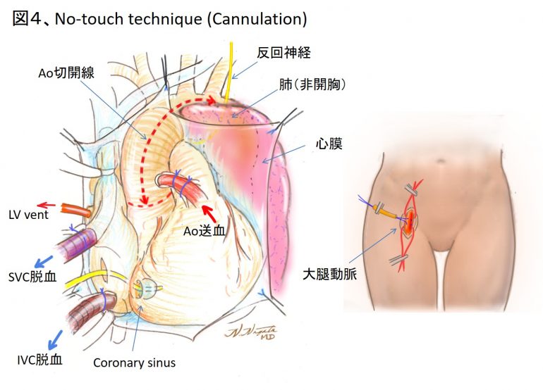 胸部大動脈瘤と解離性大動脈瘤の治療｜マルファン・大動脈・ハート
